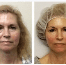 Before and After Image: Neurotris Microcurrent - other