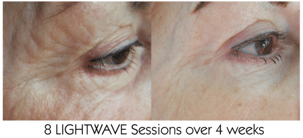 Before and After Image: Lightwave LED - other