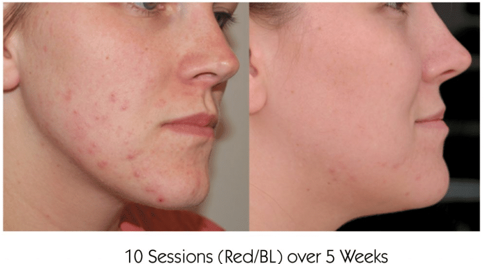 Before and After Image: Lightwave LED - other