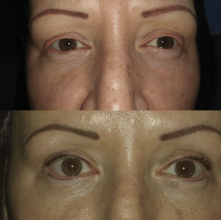 Before and After Image: Permanent Cosmetics - other