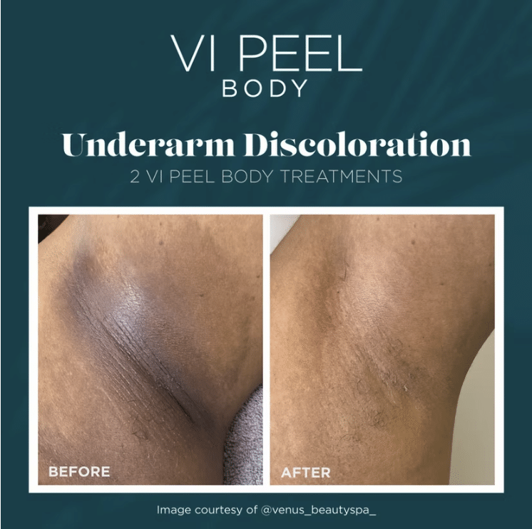 Before and After Image: VI Chemical peels - other