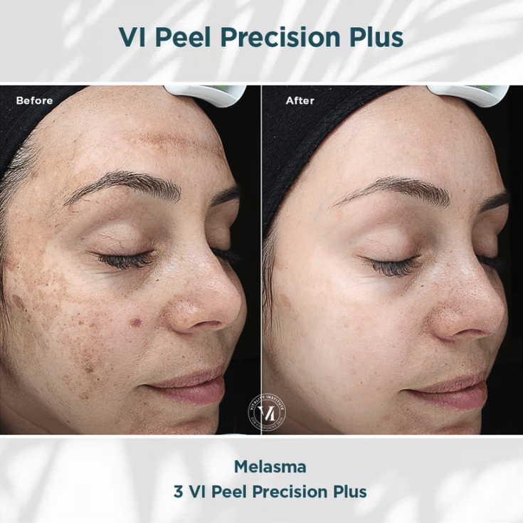 Before and After Image: VI Chemical peels - other