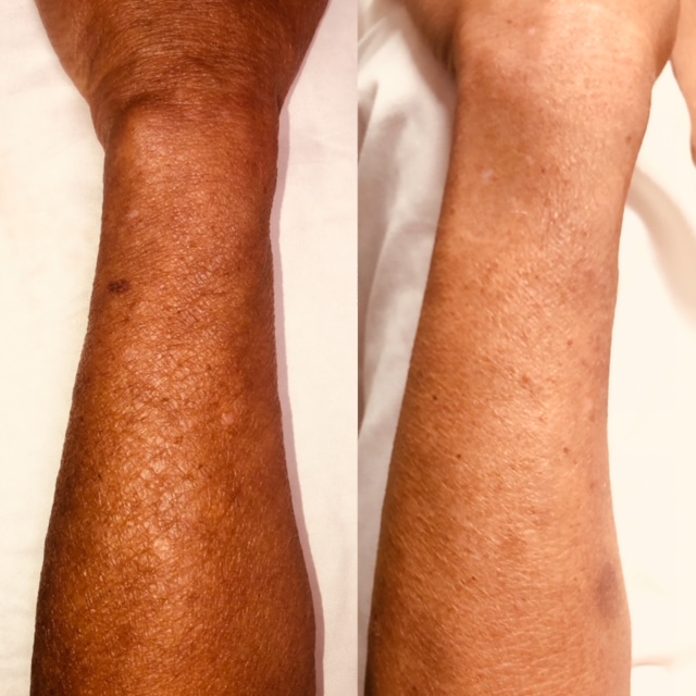 Before and After Image: BioRePeel - front