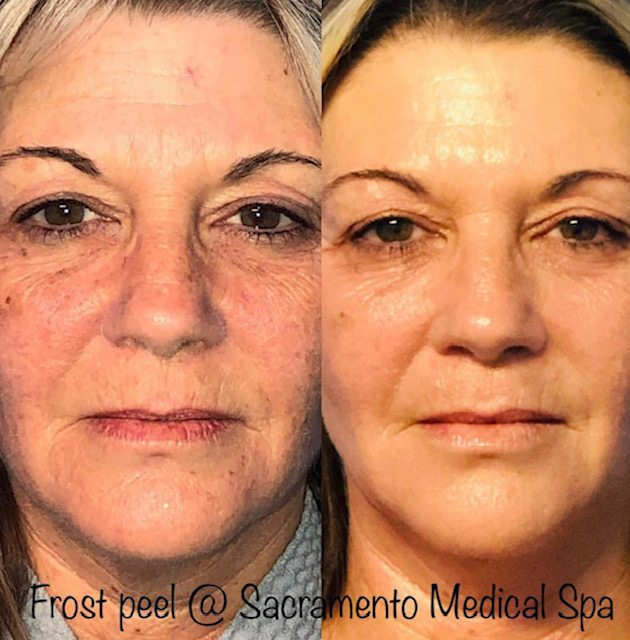 Before and After Image: Frost Peel - front