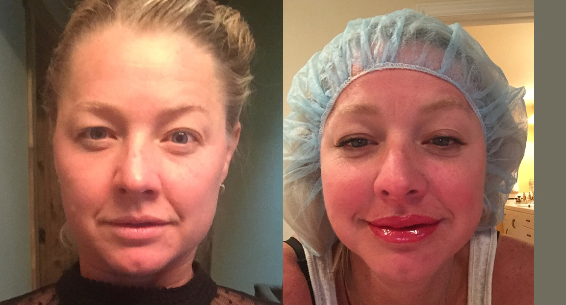 Before and After Image: Lip Blushing - front