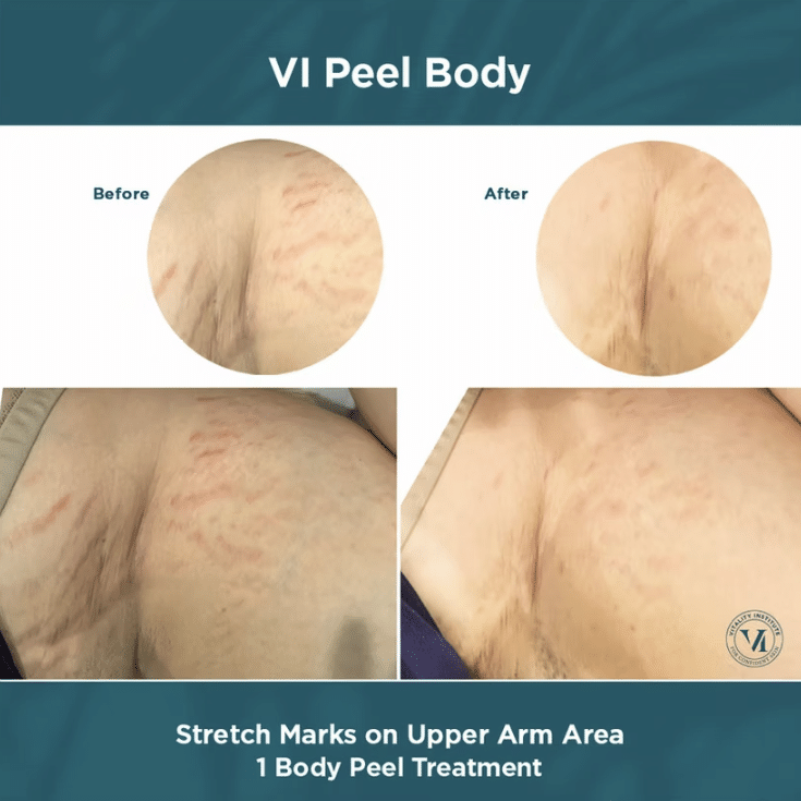 Before and After Image: VI Chemical peels - other