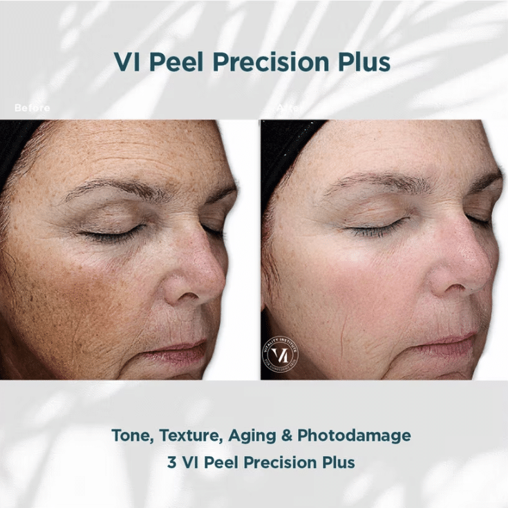 Before and After Image: VI Chemical peels - other